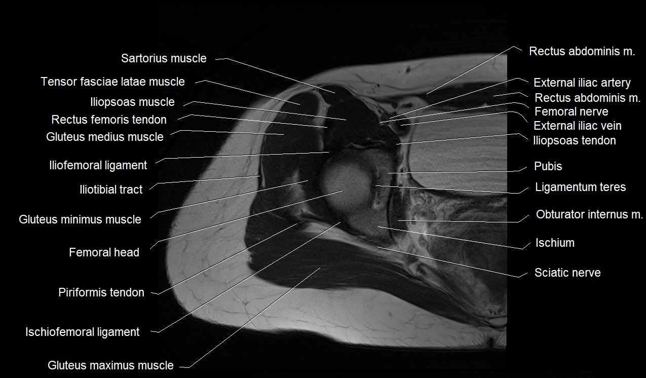 MRI thigh cross sectional anatomy image 5.webp